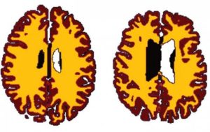 brains-scans-of-lean-vs-obese-person